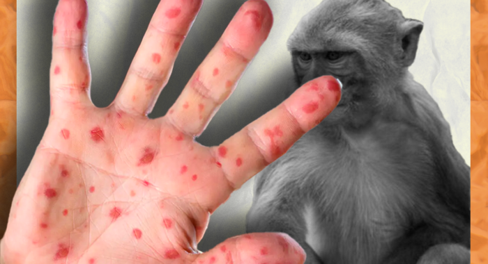 EEUU ya es el país con más casos detectados de la viruela del mono en el mundo