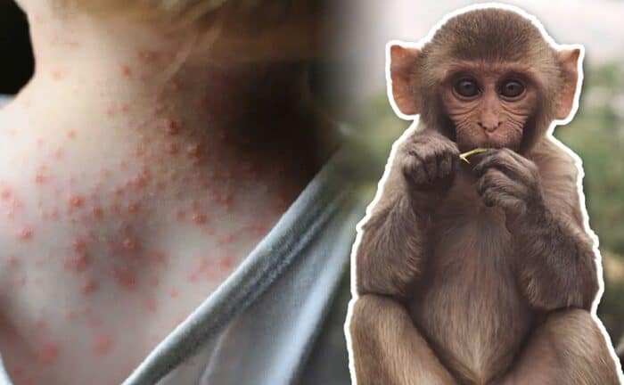 Reportan primer caso de viruela del mono en Guatemala